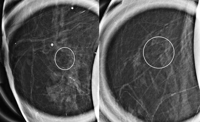 Case: Atypical Ductal Hyperplasia Figure 1