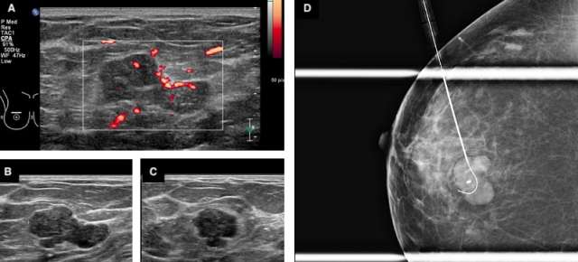 Case: Phyllodes Tumors Figure 2