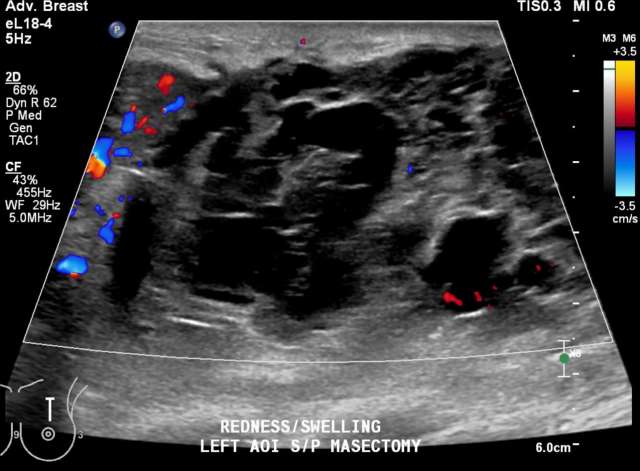 Case: Post-Surgical Fluid Collections Figure 1