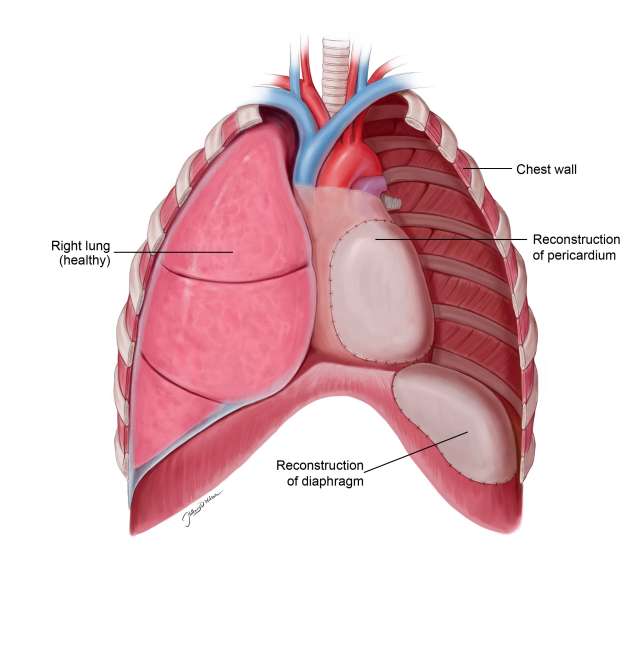 Anatomical diagram of lungs with labeled structures including diaphragm and pericardium.