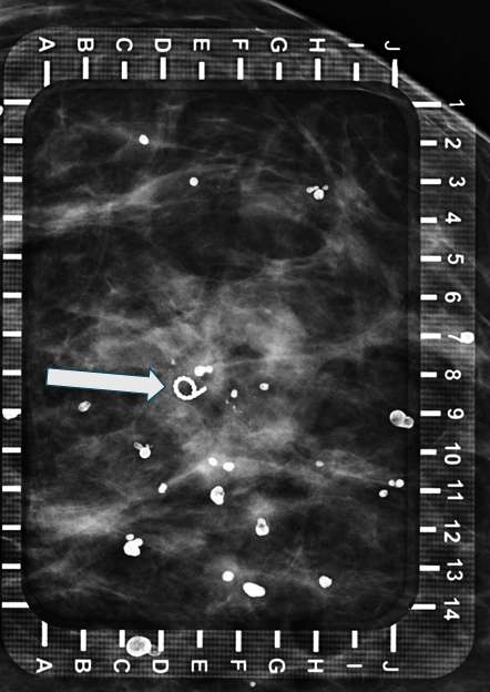 Procedure Mammographically Guided Wire Localizations Figure 1