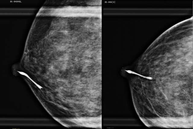 Procedure Ductography Figure 1