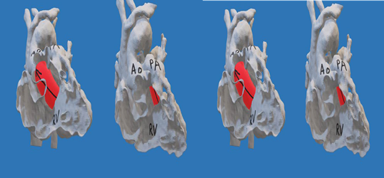 3d heart models of left and right heart