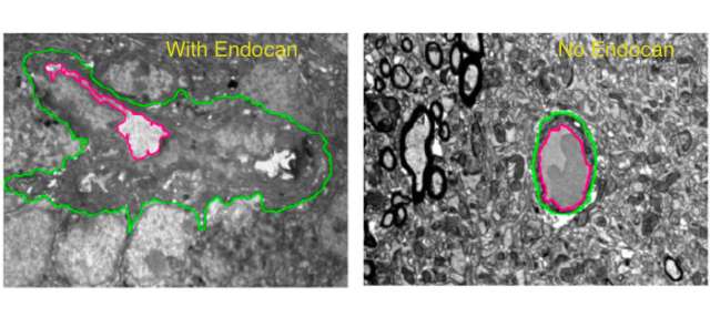 glioblastoma cells