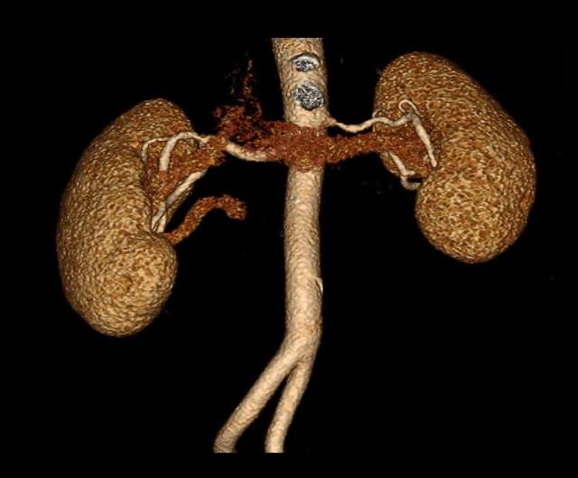 Kidney Donor Evaluation