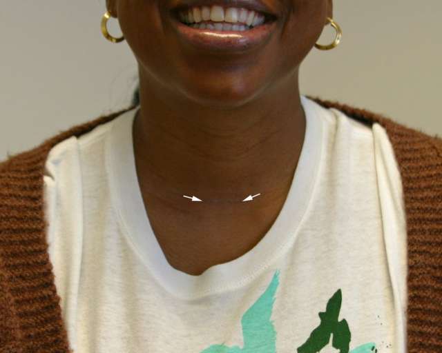 Scar Benign thyroid 3 months after surgery