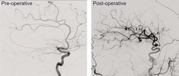 CT scans of pre and post op moyamoya disease treatment