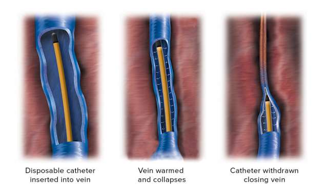 Diagram of VNUS Closure Procedure