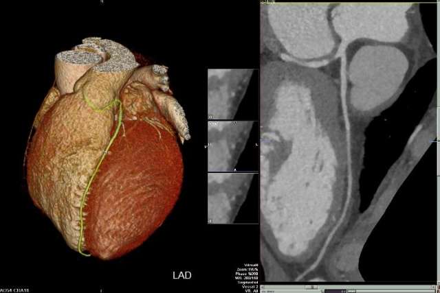 Coronary Arteries