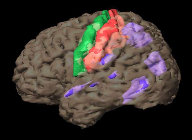 Image scan of a brain with epilepsy