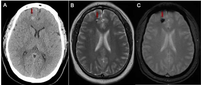 CT scan of the brain