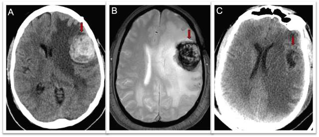 Brain CT scan