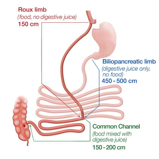 Gastric Bypass Revison