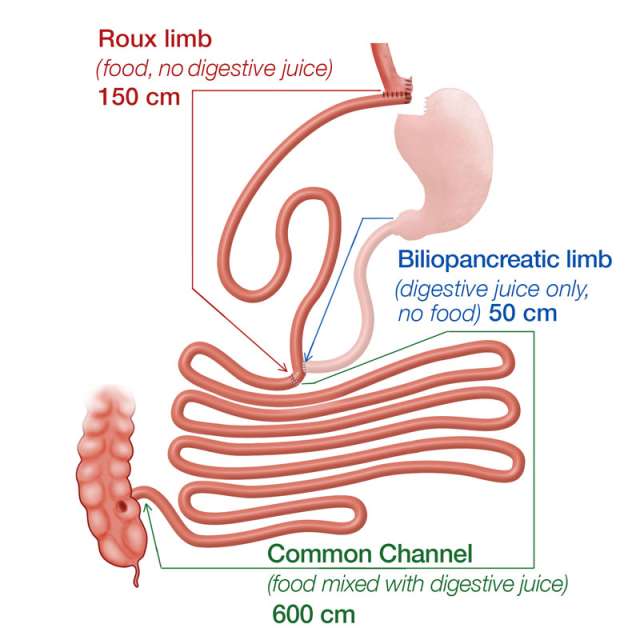 Gastric Bypass Revison