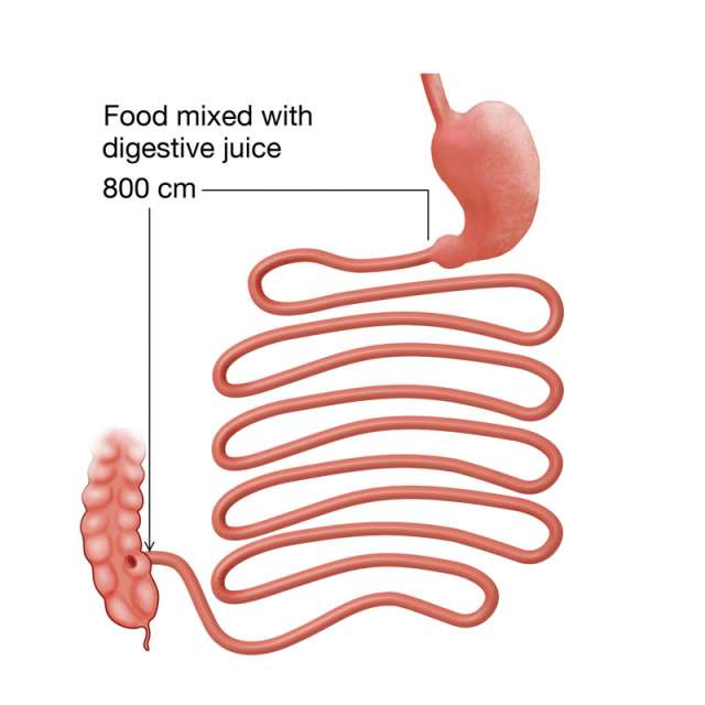Gastric Bypass Revison