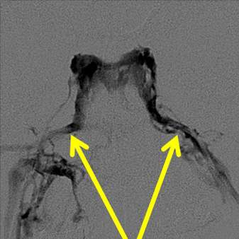 Tips of the catheters in the inferior petrosal sinuses.