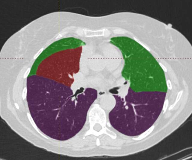 Lobar Segmentation