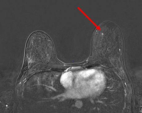 Figure 1. T1 fat-saturated postcontrast axial subtraction MRI demonstrating an enhancing focus in the left breast at 11 o’clock anterior depth.
