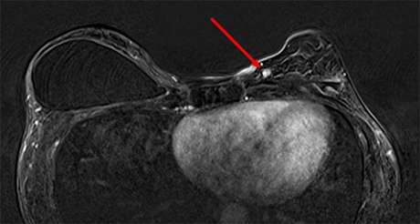 T1 fat-saturated postcontrast axial subtraction MRI
