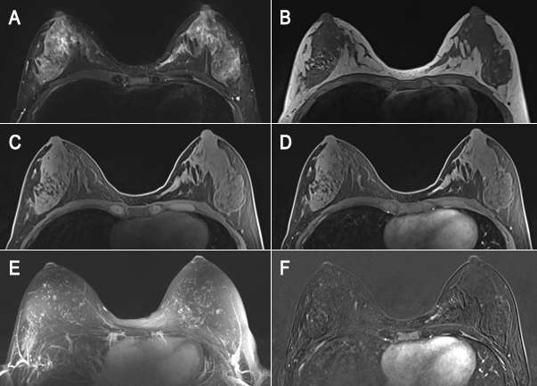 Female with BRCA1 mutation underwent breast cancer screening