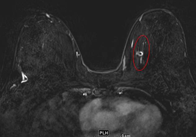Biopsy-Proven DCIS as Linear, Heterogeneous NME.