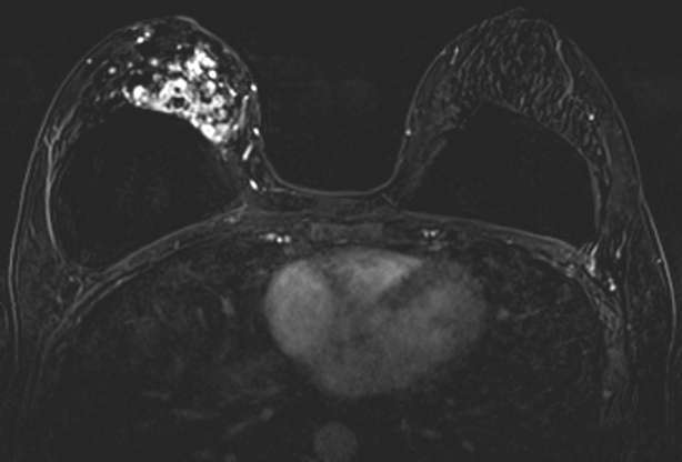 Biopsy-Proven IDC and DCIS as Segmental, Clustered Ring NME.