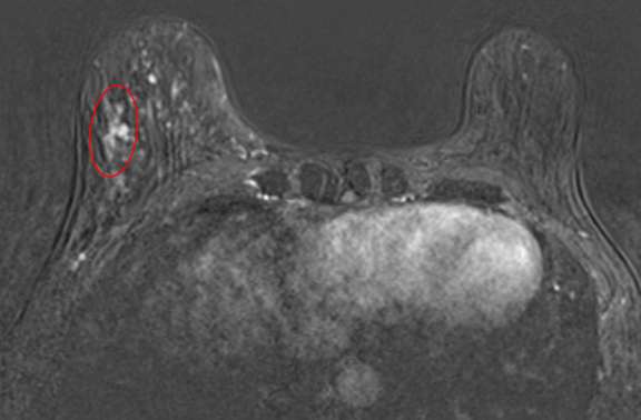 Biopsy-Proven Microinvasive Ductal Carcinoma as Linear, Clumped NME