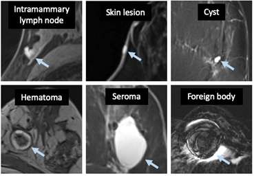 BI-RADS lexicon for examples of findings.