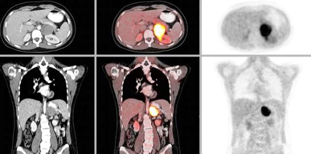 Pheochromocytoma Scan