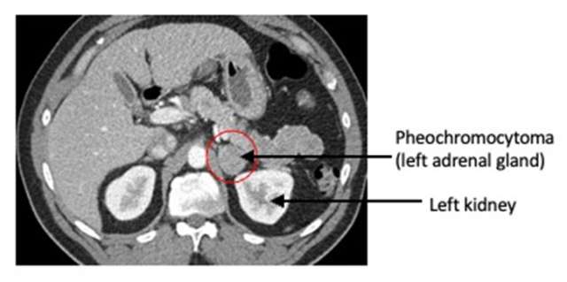 Pheochromocytoma, left adrenal gland