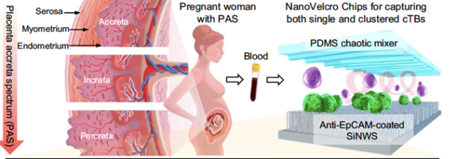 Placenta Accreta