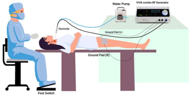 Illustration of RFA Procedure