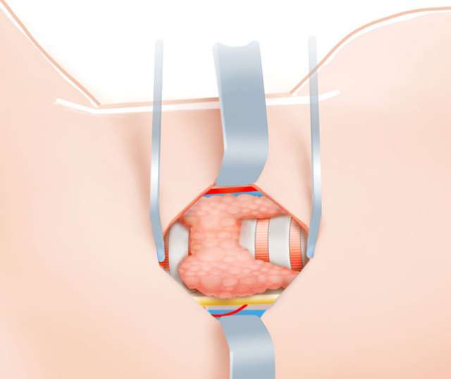 Thyroid Surgery Step 5 Exposure of the thyroid