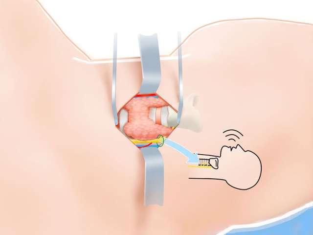 Thyroid Surgery Step 8 Identification/Preservation Laryngeal Nerve