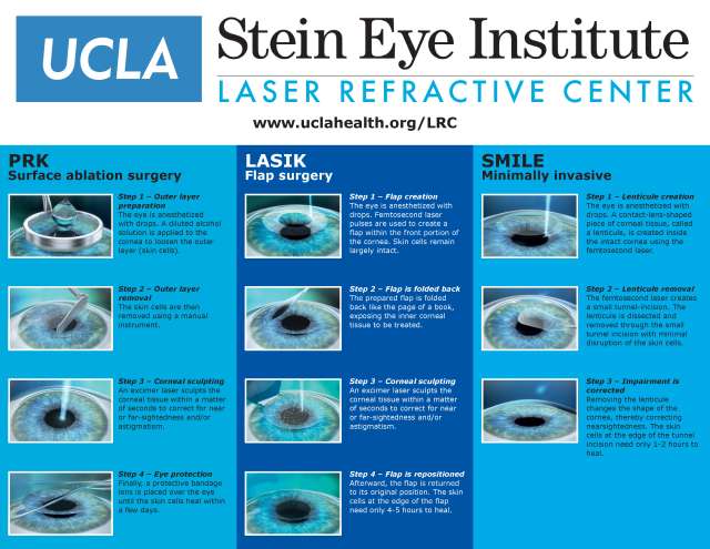 A visual guide of UCLA Stein Eye Institute's Laser Refractive Center presents a visual comparison of PRK, LASIK , and SMILE vision correction steps.