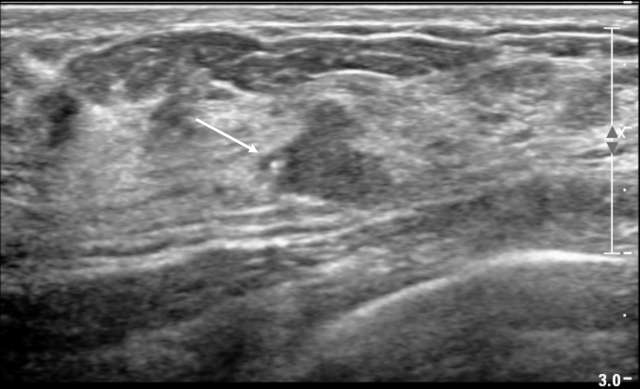 Irregular mass in the breast with punctate echogenic foci