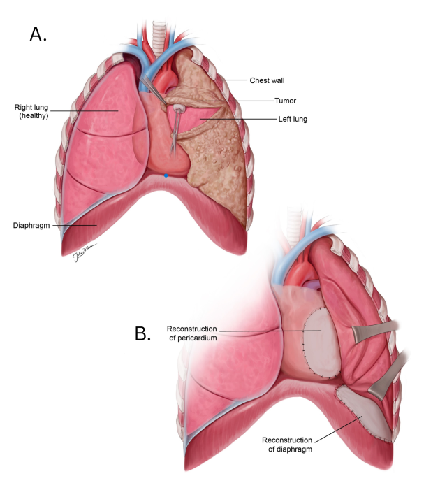 Detailed illustration of human lungs, showing anatomical structures and reconstruction.