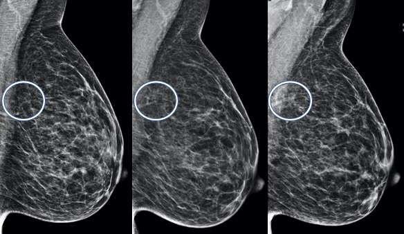 Serial MLO view of the left breast (from oldest to newest) demonstrate increase density in the left superior breast consistent with a developing asymmetry. This particular case turned out to be biopsy-proven pseudoangiomatous stromal hyperplasia.