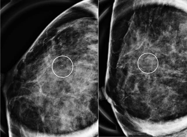 Case: Atypical Ductal Hyperplasia Figure 2
