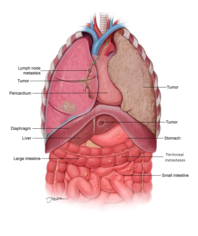 Illustration of human internal organs highlighting tumors and other structures.