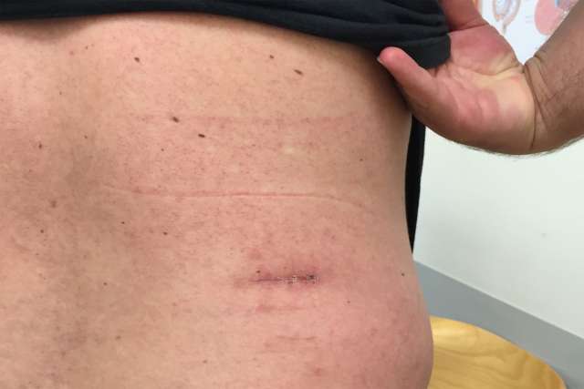 Link, image, Retroperitoneoscopic Adrenalectomy Scar