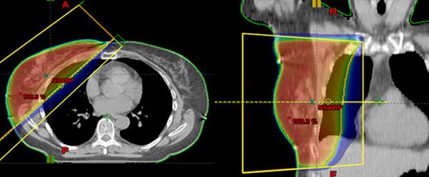 breast cancer