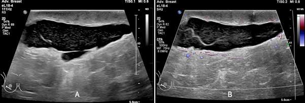 Case: Seromas and Hematomas