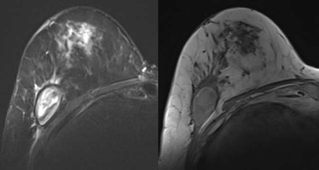 Case: Post-Surgical Fluid Collections Figure 6
