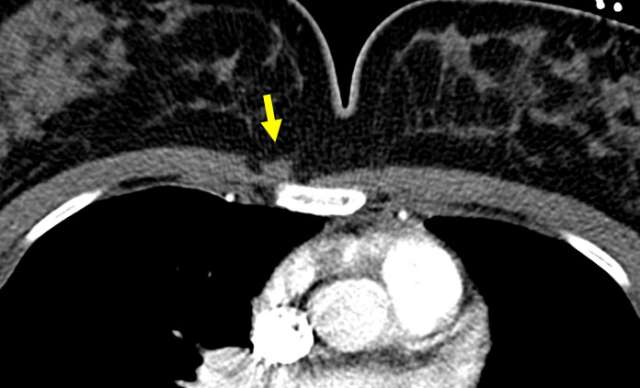 Case Sternalis Muscle Figure 2