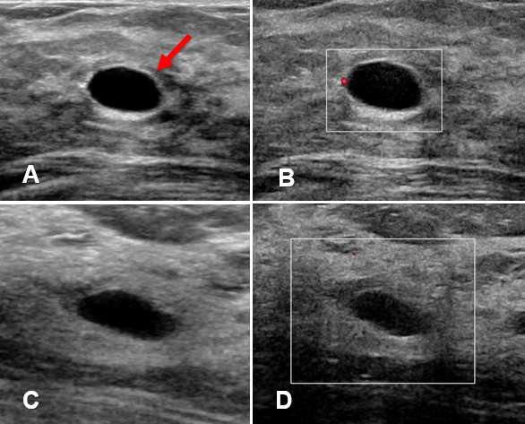 Case: Cysts figure 1