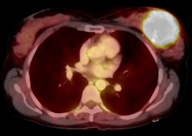 Case: Breast Sarcoma Figure 3