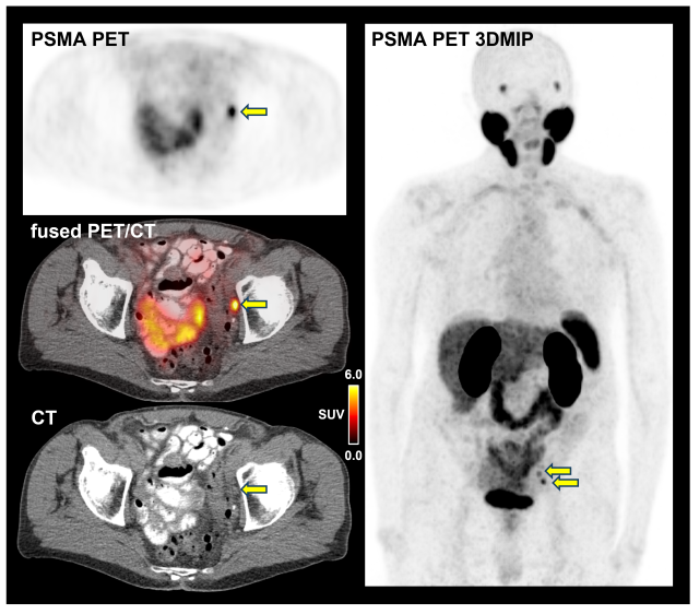 PSMA-PET/CT scan of an 85-year-old patient with hormone-sensitive prostate cancer.