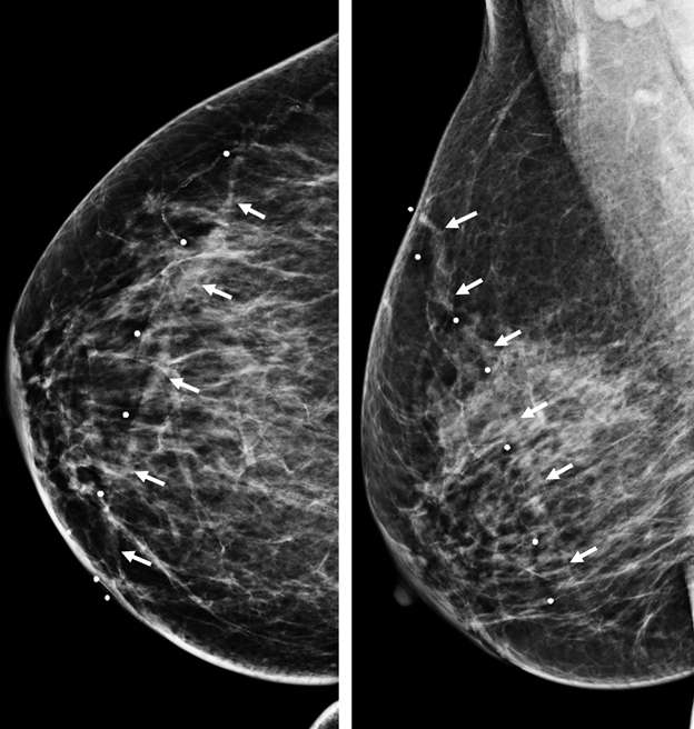 Superficial thrombophlebitis