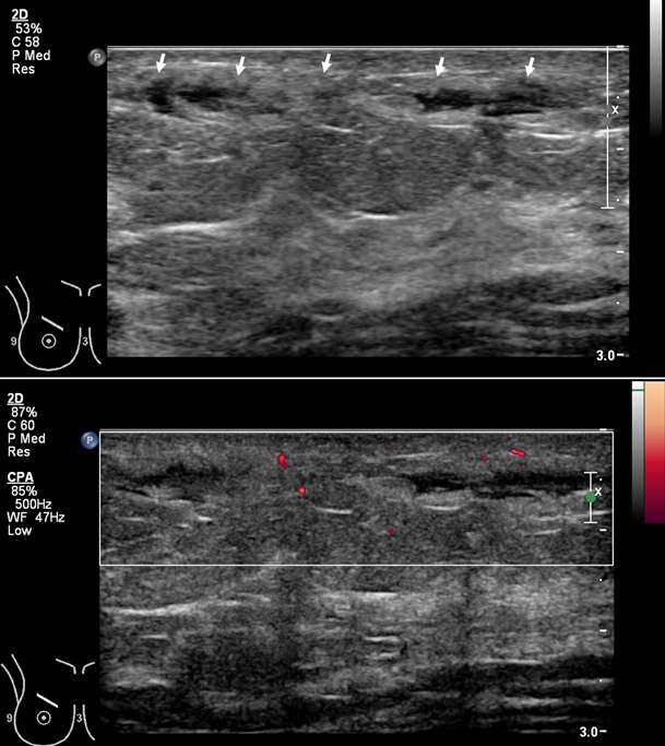 Superficial thrombophlebitis